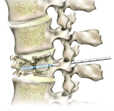 Understanding The Balloon Kyphoplasty Procedure Spine Center Miami